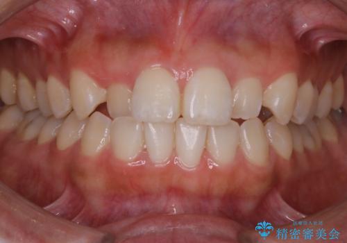 【非抜歯】部分矯正でも治る 前歯の反対咬合の症例 治療前