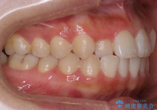 【非抜歯】部分矯正でも治る 前歯の反対咬合の治療前