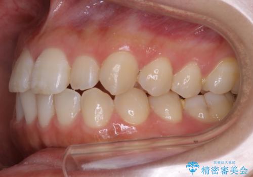 【非抜歯】部分矯正でも治る 前歯の反対咬合の治療前