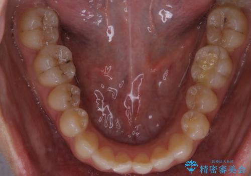 【非抜歯】部分矯正でも治る 前歯の反対咬合の治療前