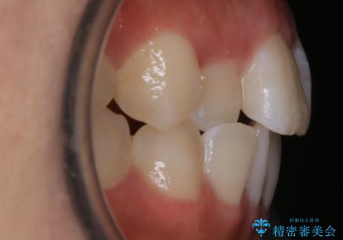 【非抜歯】部分矯正でも治る 前歯の反対咬合の治療前