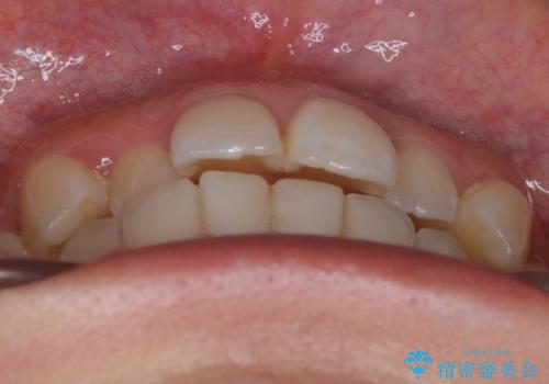 【非抜歯】部分矯正でも治る 前歯の反対咬合の治療前