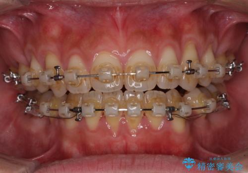 隙間が空いて突出した前歯を治したい ワイヤー装置による抜歯矯正の治療中