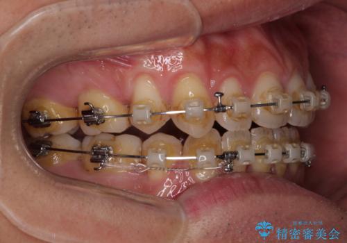 隙間が空いて突出した前歯を治した　ワイヤー装置による抜歯矯正の治療中