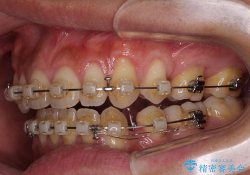 隙間が空いて突出した前歯を治したい ワイヤー装置による抜歯矯正の治療中