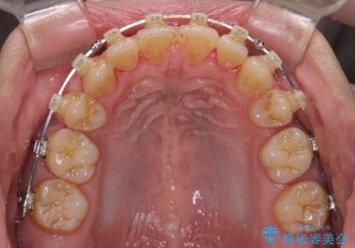 隙間が空いて突出した前歯を治したい ワイヤー装置による抜歯矯正の治療中