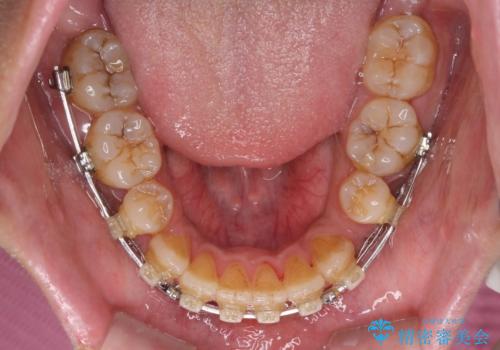隙間が空いて突出した前歯を治した　ワイヤー装置による抜歯矯正の治療中