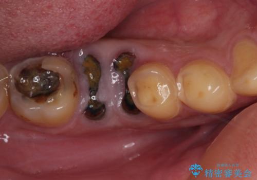放置した虫歯　奥歯のオールセラミックブリッジ治療の症例 治療前