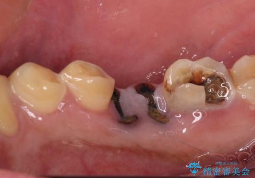 放置した虫歯 奥歯のオールセラミックブリッジ治療の治療前