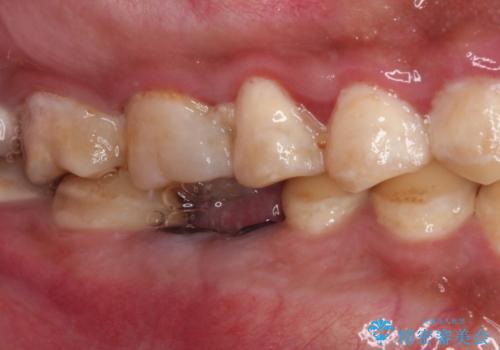 放置した虫歯　奥歯のオールセラミックブリッジ治療の治療前