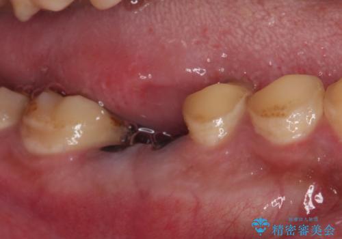 放置した虫歯 奥歯のオールセラミックブリッジ治療の治療前
