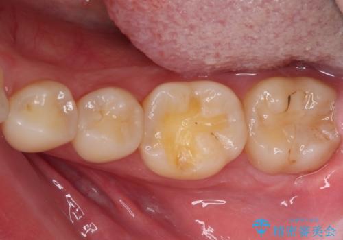 左下の奥歯が冷たいものがしみてザラザラする ゴールドインレー修復 の治療中