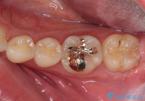 左下の奥歯が冷たいものがしみてザラザラする　ゴールドインレー修復　の症例 治療後