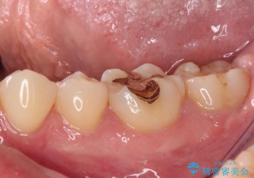 左下の奥歯が冷たいものがしみてザラザラする ゴールドインレー修復 の治療後