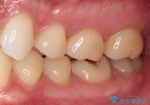 左下の奥歯が冷たいものがしみてザラザラする ゴールドインレー修復 の治療後