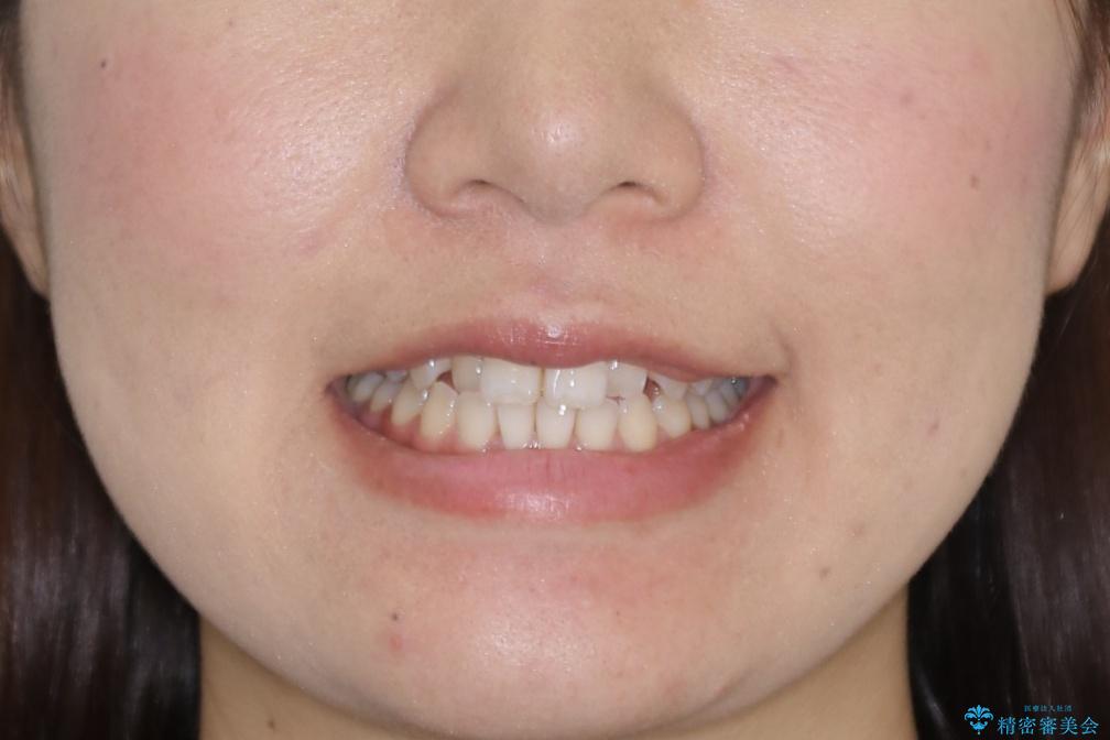 【非抜歯】部分矯正でも治る 前歯の反対咬合の治療前(顔貌)