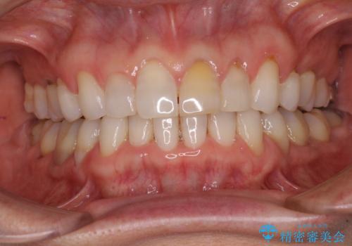 矯正治療の後戻り インビザライン・ライトでの再矯正の治療中