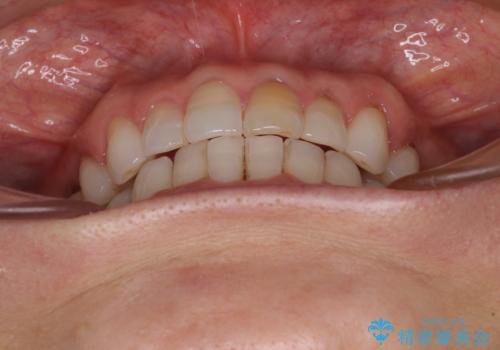 矯正治療の後戻り インビザライン・ライトでの再矯正の治療中