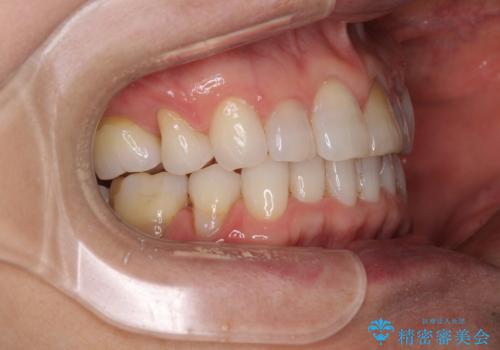 矯正治療の後戻り インビザライン・ライトでの再矯正の治療中