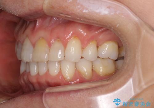 矯正治療の後戻り インビザライン・ライトでの再矯正の治療中