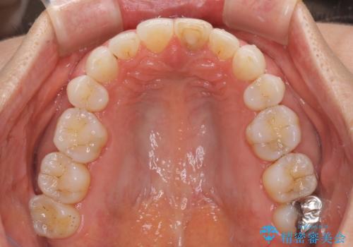 矯正治療の後戻り インビザライン・ライトでの再矯正の治療中