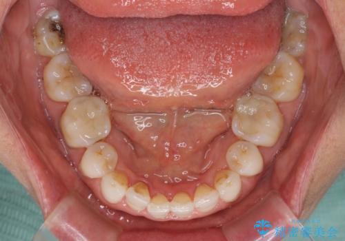 矯正治療の後戻り インビザライン・ライトでの再矯正の治療中