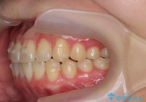 [ インビザライン ]前歯のガタつきを治したいの治療中