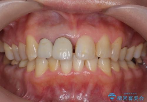 前歯のすき間　以前よりも広がってきた　二度と広がらないようにしたい　セラミック治療