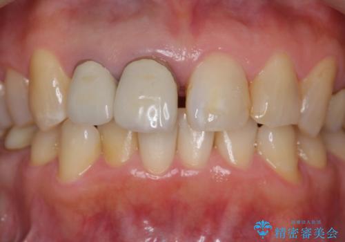 前歯のすき間　以前よりも広がってきた　二度と広がらないようにしたい　セラミック治療の治療前
