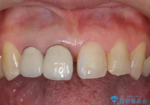 前歯のすき間 以前よりも広がってきた 二度と広がらないようにしたい セラミック治療の治療前