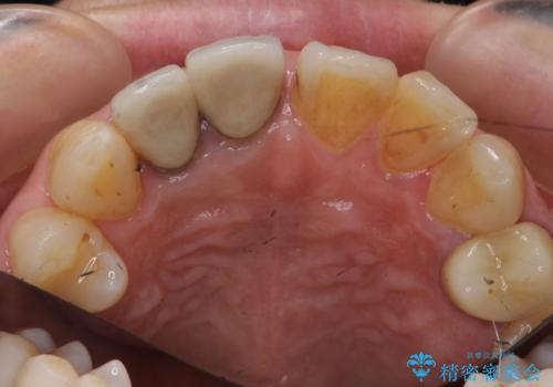 前歯のすき間 以前よりも広がってきた 二度と広がらないようにしたい セラミック治療の治療前