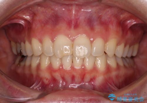 転勤予定がある インビザラインによる矯正治療の症例 治療後