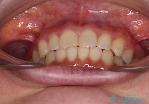 転勤予定がある インビザラインによる矯正治療の治療後