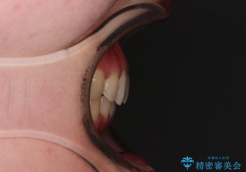 転勤予定がある インビザラインによる矯正治療の治療後