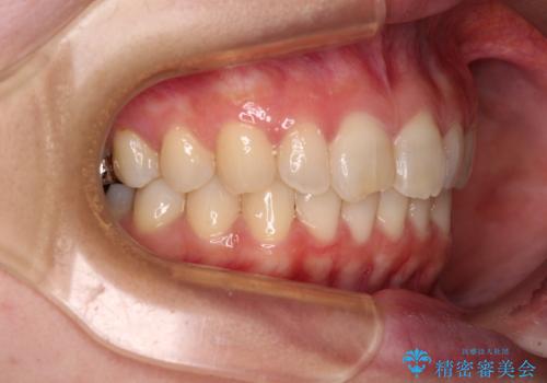 転勤予定がある インビザラインによる矯正治療の治療後