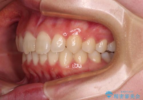 転勤予定がある インビザラインによる矯正治療の治療後