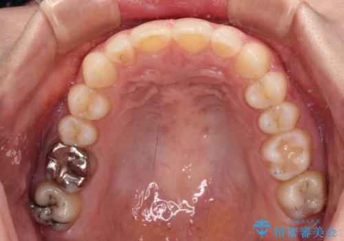 転勤予定がある インビザラインによる矯正治療の治療後