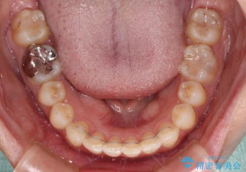 転勤予定がある インビザラインによる矯正治療の治療後