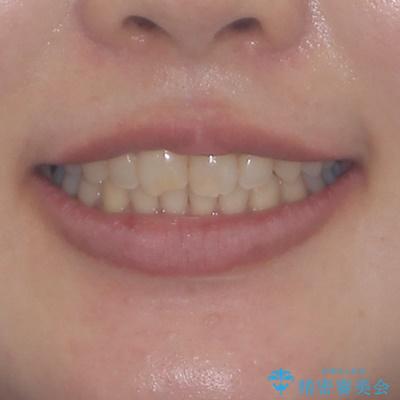 転勤予定がある インビザラインによる矯正治療の治療後(顔貌)