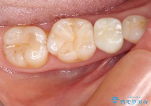 以前治療した詰め物が欠けた オールセラミッククラウンによる補綴の治療後