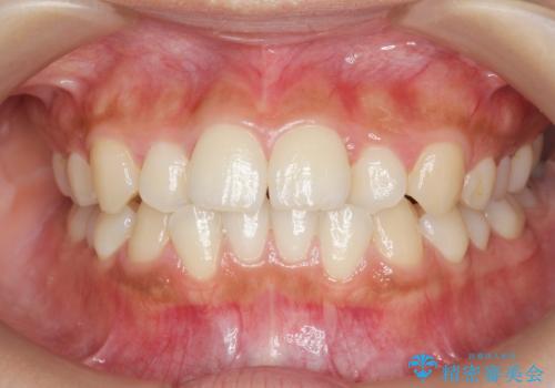 ワイヤー部分矯正を併用して治療期間を短縮 マウスピース矯正治療の症例 治療前
