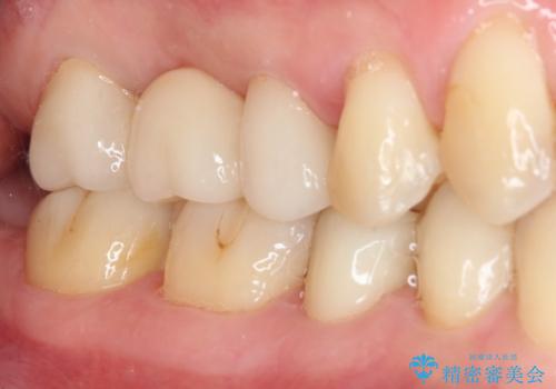 以前治療した詰め物が欠けた オールセラミッククラウンによる補綴の治療後