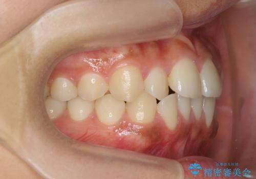 ワイヤー部分矯正を併用して治療期間を短縮 マウスピース矯正治療の治療前