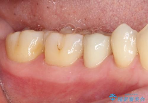 以前治療した詰め物が欠けた オールセラミッククラウンによる補綴の治療後