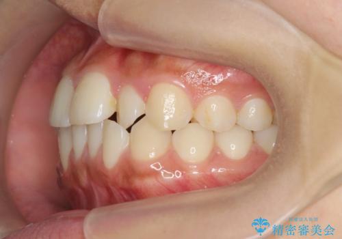 ワイヤー部分矯正を併用して治療期間を短縮 マウスピース矯正治療の治療前