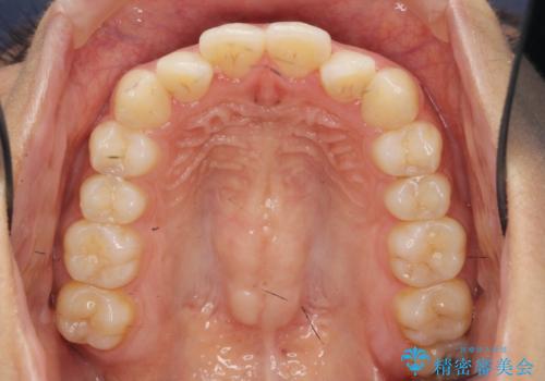 ワイヤー部分矯正を併用して治療期間を短縮 マウスピース矯正治療の治療前