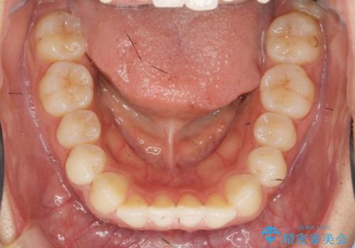 ワイヤー部分矯正を併用して治療期間を短縮 マウスピース矯正治療の治療前