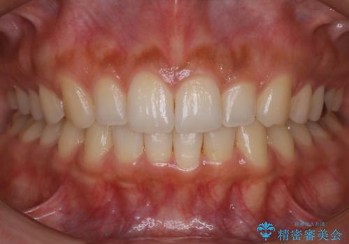 【非抜歯】狭い歯列を改善 ガタつきを治すの治療後