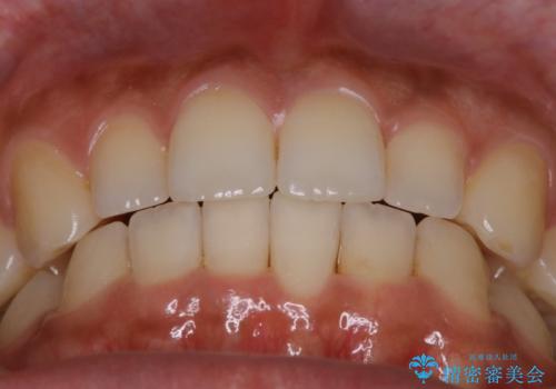【非抜歯】狭い歯列を改善 ガタつきを治すの治療後