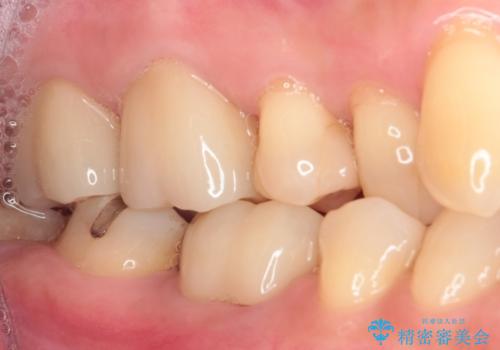 銀歯を白くしたい セラミックによる審美歯科治療の治療後